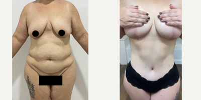 Back Lift before and after photo