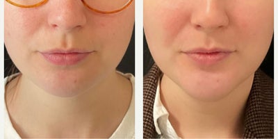 Chin Implant before and after photo