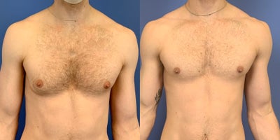 Gynecomastia Surgery before and after photo