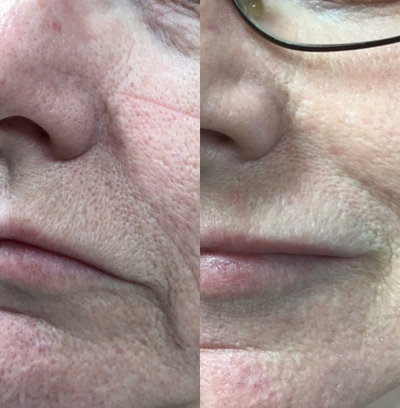 Halo Laser before and after photo