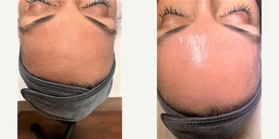 HydraFacial before and after photo
