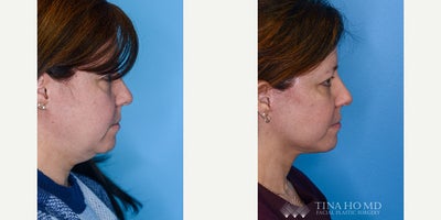 Neck Lift before and after photo