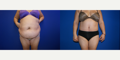 Tummy Tuck before and after photo