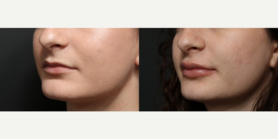 Lip Fillers before and after photo
