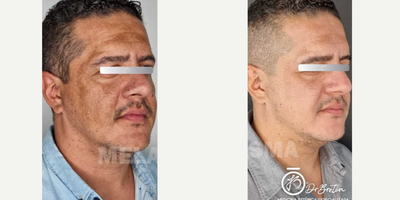 Skin Rejuvenation before and after photo