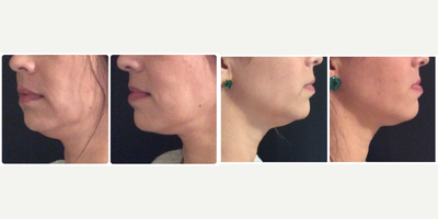 CoolMini before and after photo