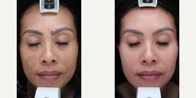 Cosmelan before and after photo