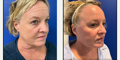 Facelift before and after photo