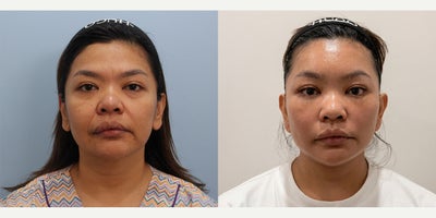 Deep Plane Facelift before and after photo