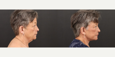 Facelift before and after photo