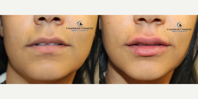 Lip Fillers before and after photo