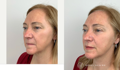 Lip Fillers before and after photo