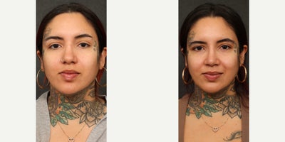 Rhinoplasty before and after photo