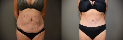 Tummy Tuck before and after photo