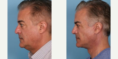 Eyelid Surgery before and after photo