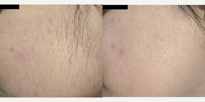 Laser Hair Removal before and after photo