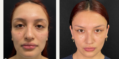 Brow Lift before and after photo