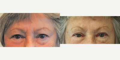 Eyelid Surgery before and after photo