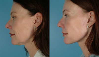 Facelift before and after photo