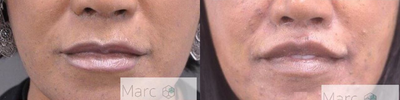 Lip Lift before and after photo