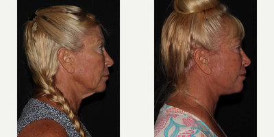 Lip Lift before and after photo