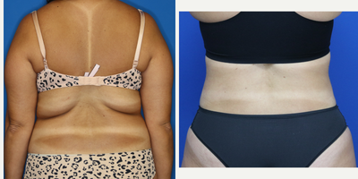 Drainless Tummy Tuck before and after photo