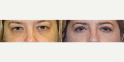 Eyelid Surgery before and after photo