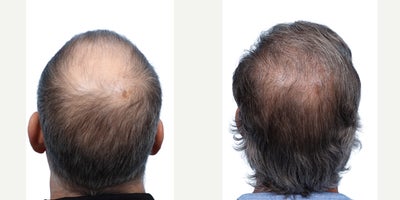 Hair Transplant before and after photo