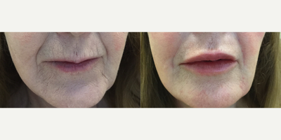 Juvederm before and after photo
