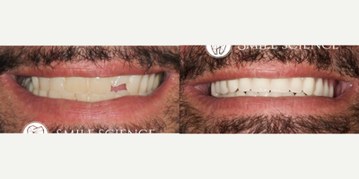Teeth Whitening before and after photo