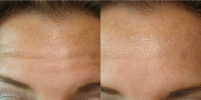 Botox before and after photo