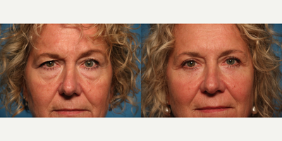 Eyelid Surgery before and after photo