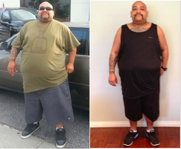 Gastric Sleeve Surgery before and after photo