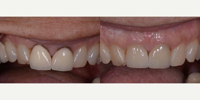 Porcelain Veneers before and after photo