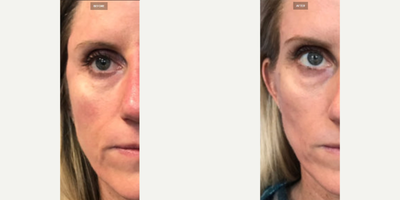 Sculptra before and after photo