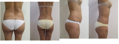 Tumescent Liposuction before and after photo