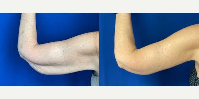 Arm Lift before and after photo