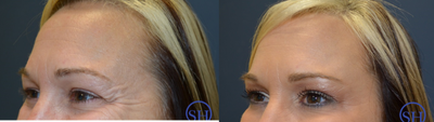 Botox before and after photo