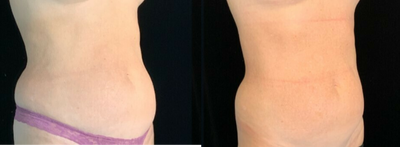 Emsculpt before and after photo