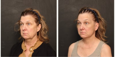Lower Facelift before and after photo