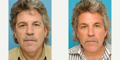 Neck Lift before and after photo