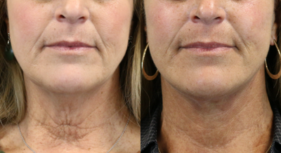 Neck Lift before and after photo