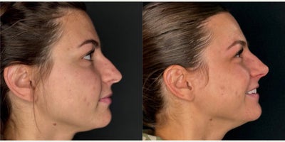 Rhinoplasty before and after photo