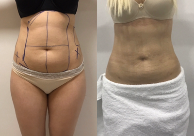 Vaser Liposuction before and after photo