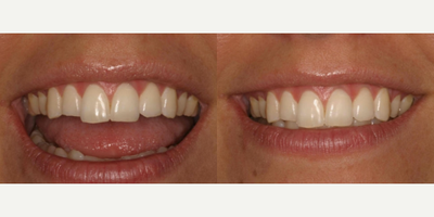 Dental Bonding before and after photo