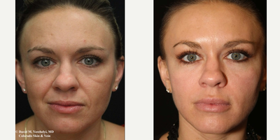 Dermal Fillers before and after photo