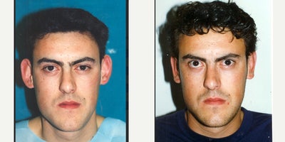 Ear Surgery before and after photo