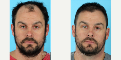 FUE Hair Transplant before and after photo
