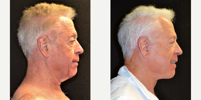 Neck Lift before and after photo