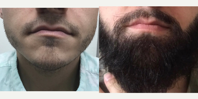 Beard Transplant before and after photo